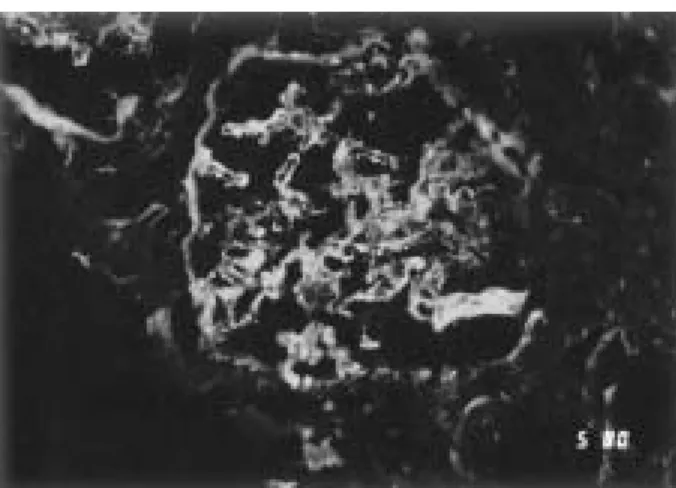 Fig. 2. Renal biopsy. Electron microscopy showed global effacement of foot process, scattered deposition of electron-dense materials in subepithelial regions ( x 15000).