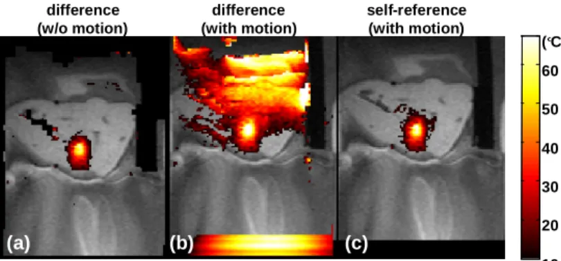 Figure 1 Relative temperature maps. (a): difference method without  simulated motion. (b): difference method with simulated motion