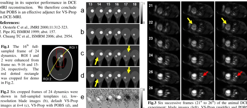 Figure 2 demonstrated six consecutive frames (13 th  to 18 th ) in cropped views from the 24 dynamics for the original full-sampled images (Fig.2a),  low-resolution blade images (Fig.2b), VS-Prop images at k=5 (Fig.2c), VS-Prop with POBS after three iterat
