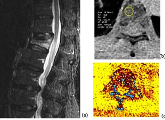 Fig. A 60-year-old man with a thoracic compression fracture. (a) Sagittal STIR MR image shows the edematous  body of T2 high signal