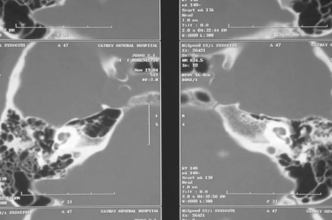 Fig 2. High-resolution CT of the temporal bone. No cochlear ossification or abnormality in the middle ears is evident.