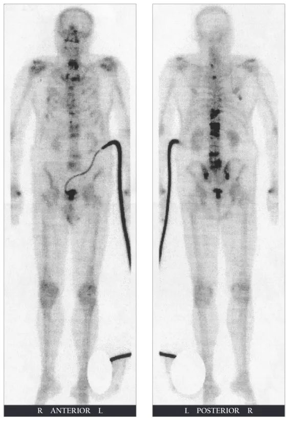 Fig. 2 (A) Bone scan showing skeletal metastases in the ribs, T1-L5 spine, sacrum, and both sacroiliac joints.