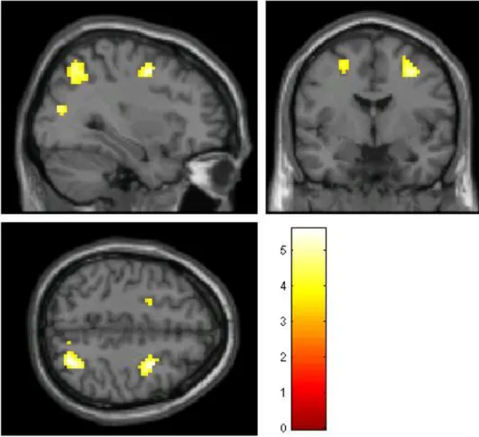 Figure 4b: the BOLD response (schizophrenia > controls) 