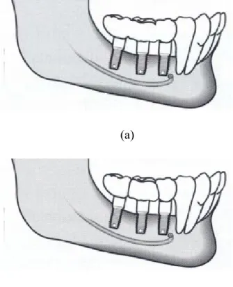 Fig 4  The crowns of these implants are modeled as connected and  disconnected to mimic (a) the splinted and (b) non-splinted designs