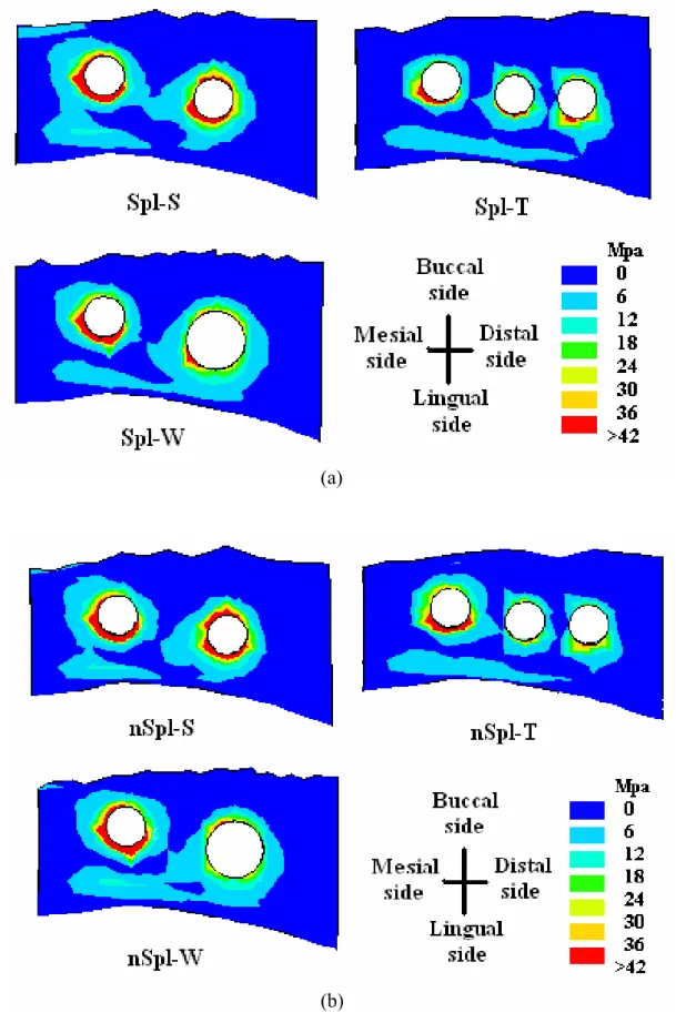 Fig 12    The von Mises stress distributions on the crest bone for the  models with (a) splinted crowns and (b) non-splinted crowns