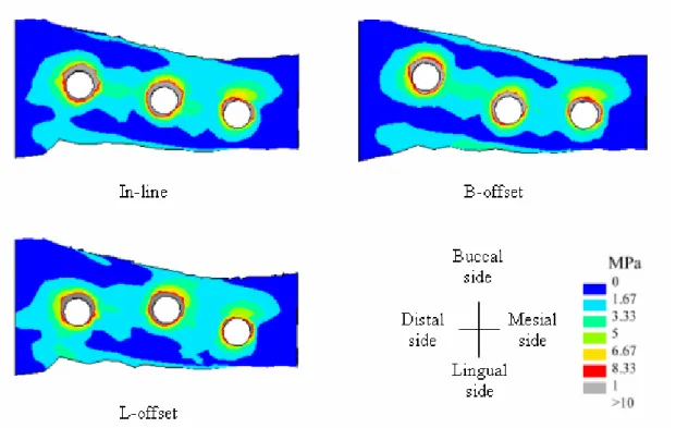 Fig 14    The von-Mises stress distribution of the crestal bone of the ISPP along three  placement designs under the vertical loading condition