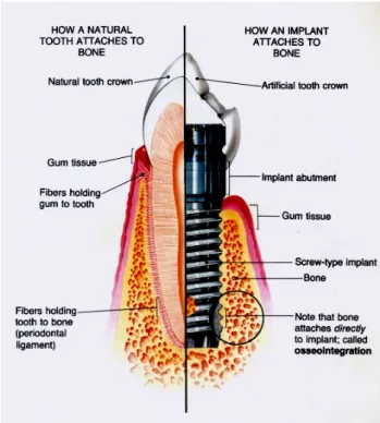 Fig 1    The bio-structure of natural tooth and implant which  attaches to bone. (Taylor 1990) 