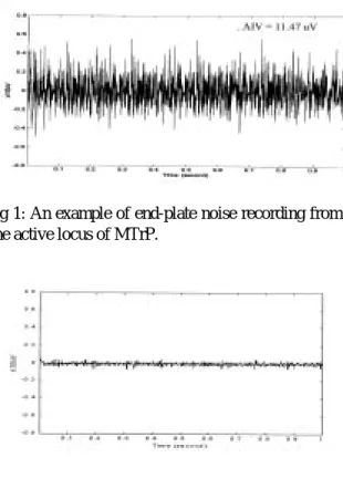 Fig 1: An example of end-plate noise recording from  one active locus of MTrP. 