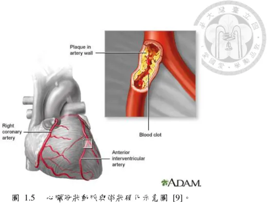 圖  1.5  心臟冠狀動脈與粥狀硬化示意圖  [9]。  發生狹窄或阻塞的起因為冠狀動脈的內皮細胞受損後，膽固醇在其內皮細胞 下堆積造成血管管腔之形變。膽固醇的堆積，使得血管的內皮細胞改變性質，易 發生血小板堆積和平滑肌增生，形成所謂的動脈粥狀硬化 [10]。一般正常的血管 內壁是平滑暢通的，一旦管壁上生成動脈粥狀硬化的腫塊，血管壁會因此變得粗 糙不平且管徑變小、血流不暢順，影響氧氣與養份的供應。動脈粥狀硬化所形成 的斑塊（plaque）在結構上又可分為穩定的斑塊與不穩定的斑塊：穩定的斑塊通常 會造成血管
