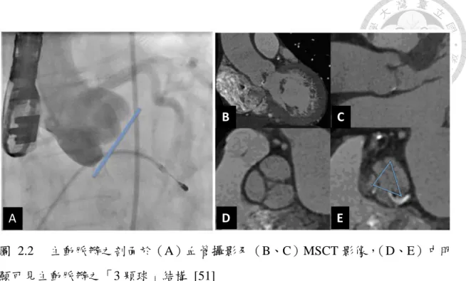 圖  2.2  主動脈瓣之剖面於（A）血管攝影及（B、C）MSCT 影像， （D、E）中明 顯可見主動脈瓣之「3 顆球」結構  [51]  同時，分割主動脈瓣亦有其重要之臨床價值，特別是針對有關安裝人工瓣膜 之臨床研究  [51]。如圖 2.2 所示，此一「3 顆球」 結構可視為心臟中之地標 （landmark）。 另一方面，冠狀動脈之起點亦各別位於「3 顆球」當中的 2 顆球上面，冠狀動脈起 點與此「3 顆球」結構之相對關係是否與其他心血管疾病有關聯，亦是未來值得持 續探討之課題。因此，在本研究的第一部份