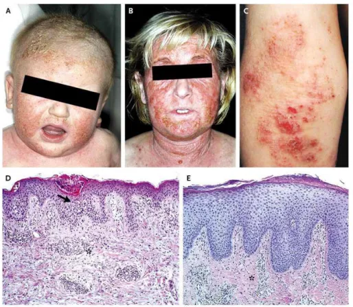 Figure 1-2. Clinical, histologic aspects of atopic dermatitis. 