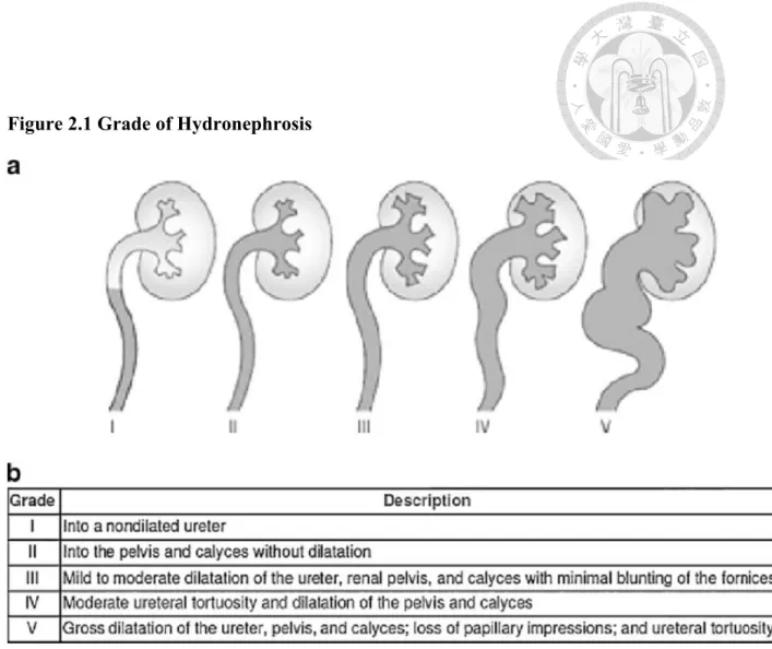 Figure 2.1 Grade of Hydronephrosis 