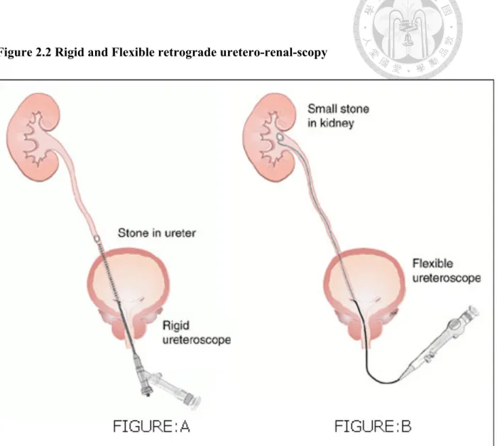 Figure 2.2 Rigid and Flexible retrograde uretero-renal-scopy 