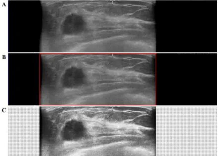 Fig.  4-2.  Steps  of  Image  Preprocessing.  (A)  The  original  ABUS  image.  (B)  The  red  rectangle showed the appropriate region for analysis excluding two lateral shadows