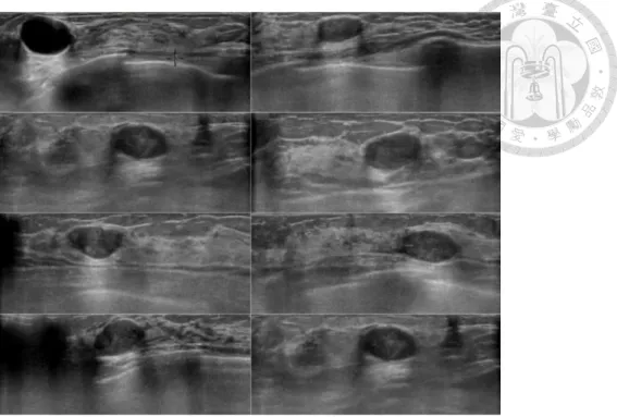 Fig.  4-5.  Rim  effect.  While  tumor  grows,  the  tissues  surrounding  the  tumor  are  compressed