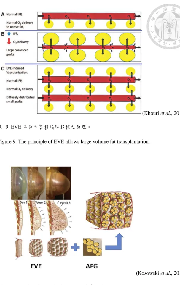 Figure 9. The principle of EVE allows large volume fat transplantation. 