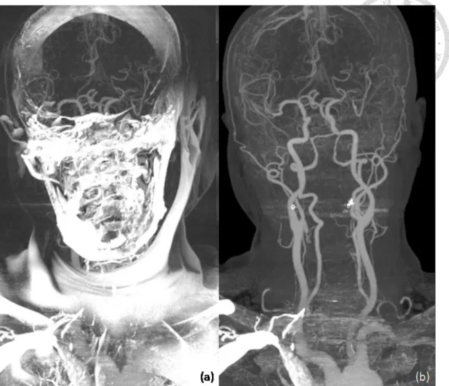 Figure 1-2: Thick maximal intensity projection (MIP) of subtraction CTA (a) without  bone registration (b) with bone registration
