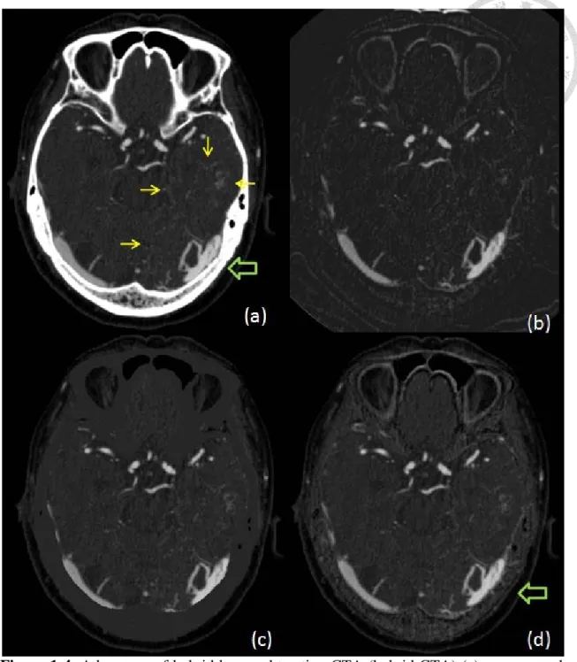 Figure 1-4: Advantage of hybrid bone subtraction CTA (hybrid CTA) (a) unprocessed  CTA image showed early enhancing isolated left transverse sinus (large arrow) and  multiple engorged medullary veins in left temporal lobe and left cerebellum (surrounded  b