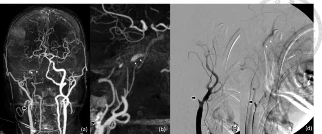 Figure 1-6: Maximal intensity projection (MIP) of hybrid CTA in frontal projection (a)  and lateral projection (b)