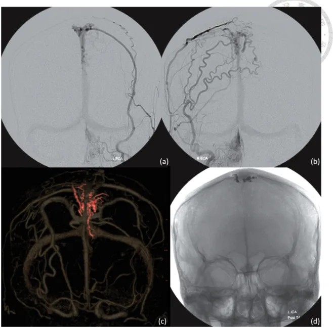 Figure 2-4: Images in 56-year-old woman with pulsatile tinnitus. (a, b) DSA images of  bilateral external  carotid arteries demonstrate the fistula, engorged cortical vein, and  superior sagittal sinus