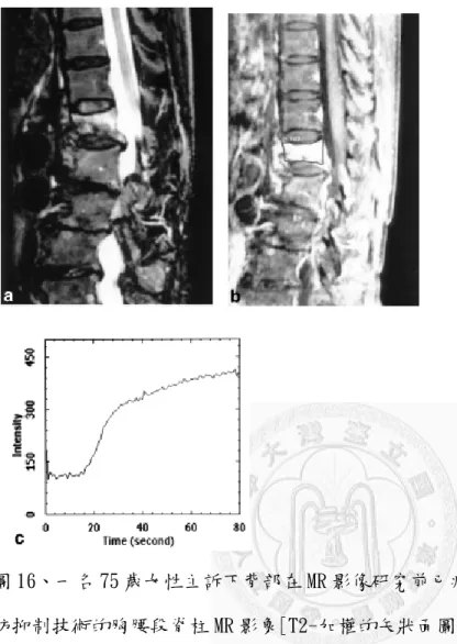 圖 16       圖 16、一名 75 歲女性主訴下背部在 MR 影像研究前已疼痛 3 週。a：一個使用脂 肪抑制技術的胸腰段脊柱 MR 影象[T2-加權的矢狀面圖像（TR/TE = 2000/80）] 顯示第 12 胸脊椎有脊椎髓水腫的骨折。b：使用脂肪抑制技術的 Gd–DTPA 給藥 後的 T1-加權的矢狀面圖像（TR/TE =600/20）顯示第 12 胸椎骨折處有明顯的不 均勻訊號增強。 c：來自第 12 胸椎的時間-訊號強度圖顯示為 E 型曲線，在陡 急顯影注入後有第二段較慢上升斜率。Y 軸以