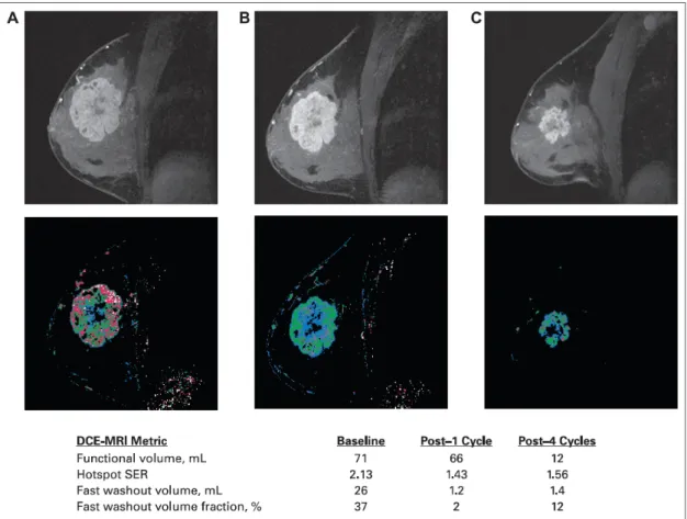 Fig 1.9 Contrast-enhanced magnetic resonance images (top row) and signal enhancement ratio (SER)  parametric maps (bottom row), acquired before treatment (A), 2 weeks after the first cycle o