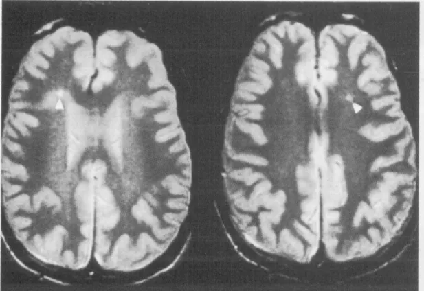 Figure II-1. T2-weighted brain MR image with hyperintensity signals  (pointed by white arrow) on the periventrcular (left) and subcortical  area (right) 