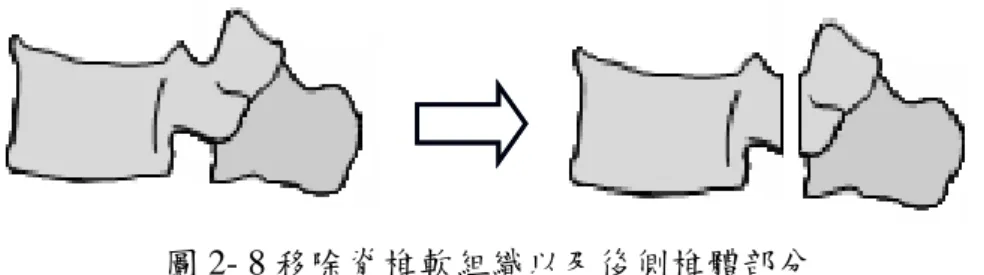 圖 2- 8 移除脊椎軟組織以及後側椎體部分      在進行注射之前先對所有試樣做楔形破壞模擬骨折，將以經分組完成的四組 試樣利用實驗室自製的 4000N 機台對各組椎骨造成不同程度的壓迫性骨折，之後 再配合不同的骨水泥濃度來進行注射並記錄觀察。  2-3-2    注射液體：骨水泥      基於實驗過程中需要設定機台以及更換注射針筒，必頇一開始就先將一個椎 骨所需注射的骨水泥量一次調配完畢並且灌注到高壓注射針筒中以縮減準備時 間。尚未注射的骨水泥在等待注射這段時間內要保持液態不能凝固，所以必頇選 用凝