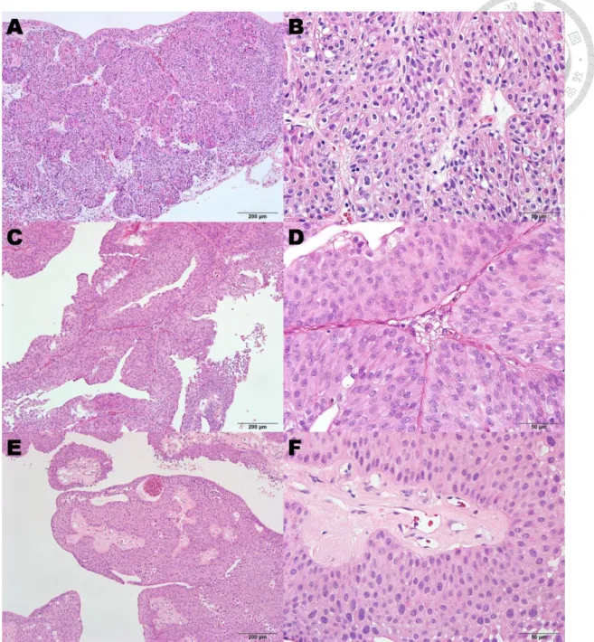 Figure 1. Representative histological images of inverted papilloma (A and B), 