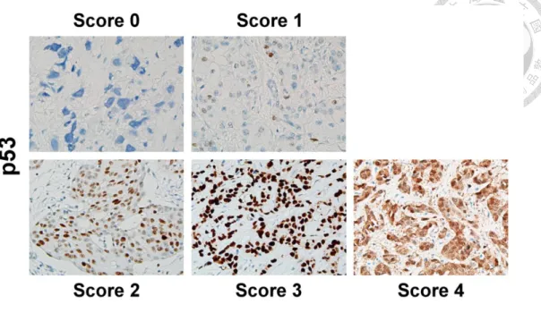 Figure 2. Scoring criteria for p53 IHC staining. Score 0: no nuclear staining in tumor 