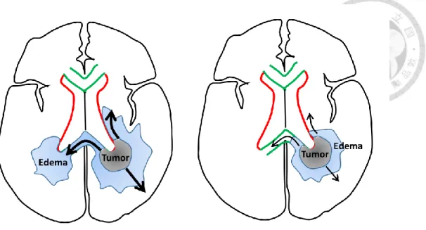 Figure 2. The correlation between tumor location with edema and tumor migration. 