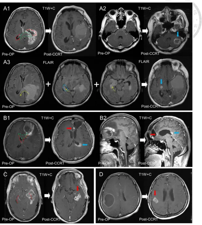 Figure 10. MRI demonstration of patients with different tumor locations. Distinct  progression patterns after CCRT in 4 patients categorized according to the different  combinations of the SVZ and CC invasion