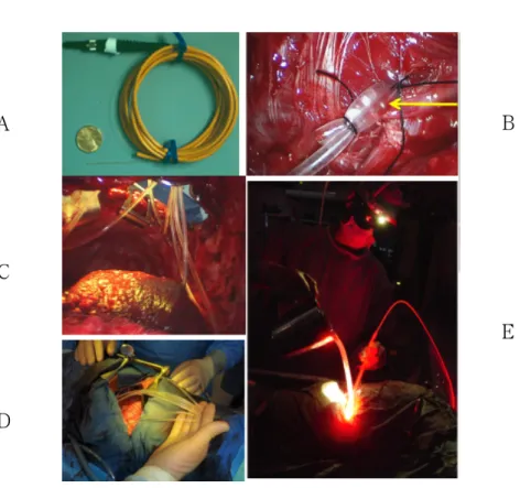 FIGURE 13. The schematic views of pleural PDT. The probes were placed in the seven regions intra-pleurally by  suture ligation