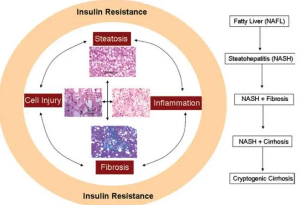 Figure 2. The progression of NAFLD   