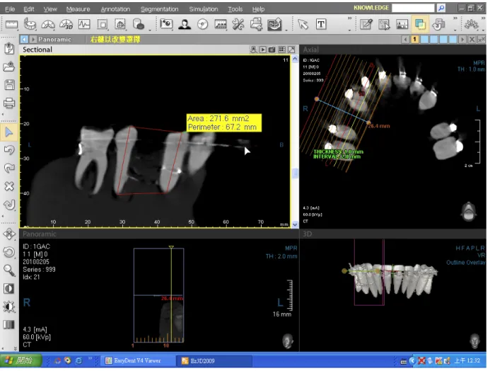 Figure 6. The computer tomography scan on the typodont.   