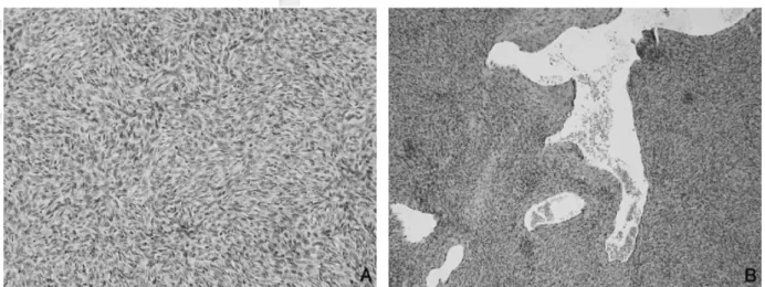 Fig. 2  Diffuse proliferation of polygonal and spindle tumor cells with round or ovoid nuclei (A)