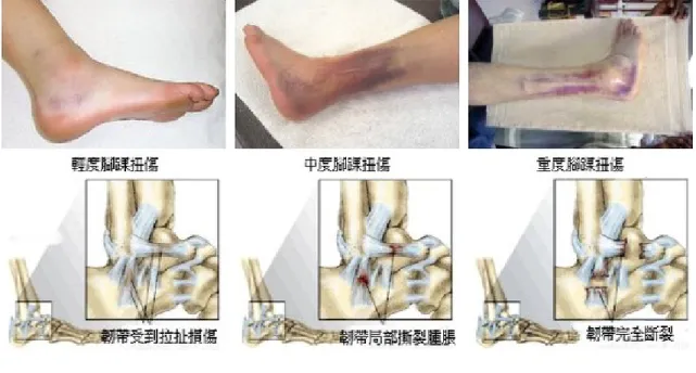 圖 2-2 韌帶扭傷 （三）肌肉拉傷 　　肌肉活動情況下，因為柔軟度不足（未充分熱 身伸展）、不正常的收縮、或協調性不良，導致肌 纖維受到拉扯受傷或甚至斷裂，較常見的是下背肌 群及股四頭肌肌拉傷。 拉傷的程度可分為三級：  輕度  ：肌肉有一小部分的肌纖維撕裂，肌肉少 量出血，在肌肉用力時或按壓患部時，才會引 起疼痛，外觀並無特殊異常。  中度    ：肌肉有相當多的肌纖維斷裂，併發血腫現象，受傷肌肉其肌力減弱、功 能性受到限制，外觀腫大。  重度    ：指肌肉的肌纖維全部斷裂，常發生於肌肉與肌腱的