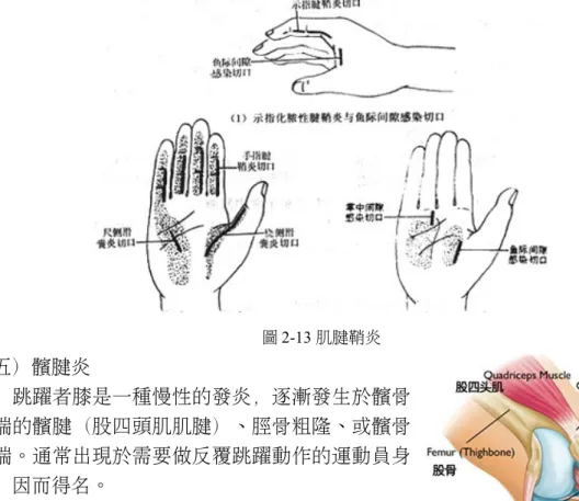 圖 2-13 肌腱鞘炎 （五）髕腱炎 　　跳躍者膝是一種慢性的發炎，逐漸發生於髕骨 上端的髕腱（股四頭肌肌腱）、脛骨粗隆、或髕骨 末端。通常出現於需要做反覆跳躍動作的運動員身 上，因而得名。 2-4-3   造成運動傷害的原因 （一）運動環境欠佳：經常在堅硬的水泥地上跑步， 而造成脛骨、後跟骨發炎或疼痛等。 （二）場地設施不良：在不平的地面上打籃球，而 造成踝關節扭傷。 （三）裝備器材不佳：在進行街道直排滑輪運動時未配帶護膝、手套及頭部護具 而造成膝蓋骨或頭部撞傷。 （四）天侯不佳：下雨時在室外打綱球可能會