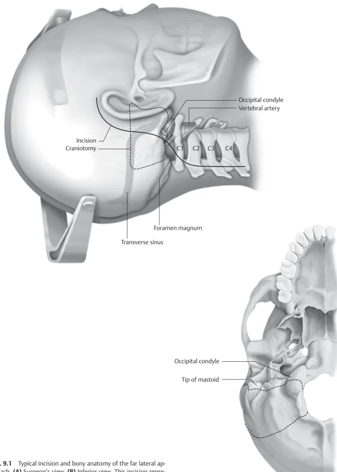 Fig. 9.1  Typical incision and bony anatomy of the far lateral ap- ap-proach. (A) Surgeon’s view
