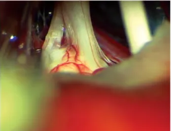Fig. 14.1  Microsurgical exposure of the trigeminal nerve for  MVD (right side). The nerve must be visualized over its entire  length, including the root entry zone