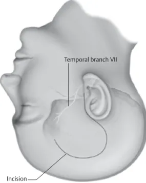 Fig. 3.3  Preauricular/temporal scalp incision. Note po- po-sition of the frontal branch of cranial nerve VII.
