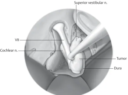 Fig. 3.9  The facial nerve is fully delineated and dissected free from the tumor  prior to tumor removal.
