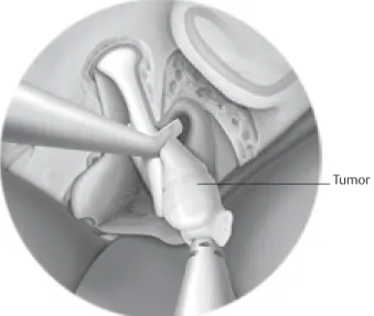 Fig. 3.10  The tumor is being removed after freeing it medially. 