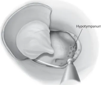 Fig. 4.5  A tympanomeatal flap is elevated with incision at the 2  and 10 o’clock positions.