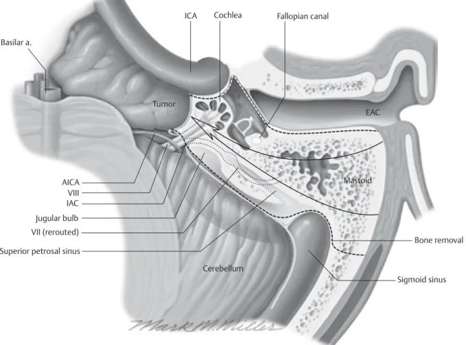 Fig. 7.1  Transcochlear approach: exposure obtained at the skull base at the completion of the approach