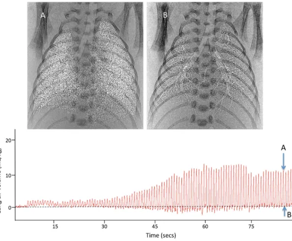 Fig. 1.2   Phase contrast x-ray images and a plethysmograph recording of a preterm newborn rabbit immedi- immedi-ately after birth ventilated from birth in the absence of a positive end expiratory pressure (PEEP)