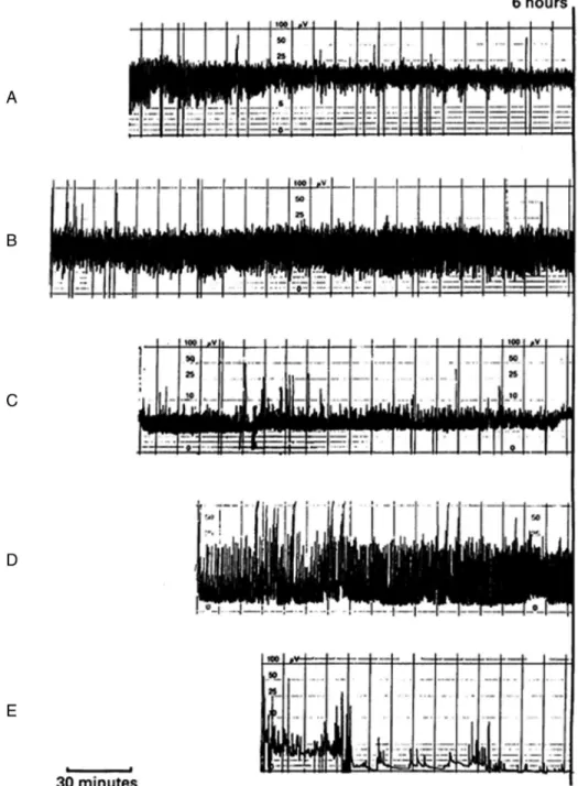 Fig. 2.4  AEEGs were recorded within 6 hours of birth among 47 term infants following perinatal asphyxia