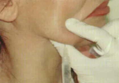 Fig. 7.13 a, b.  Illustration of grid typically employed  for injectable lipolysis of the submental region