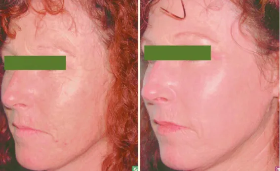Fig. 1.5.  Before (left ) and 3 months aft er (right) CO 2  laser resurfacing