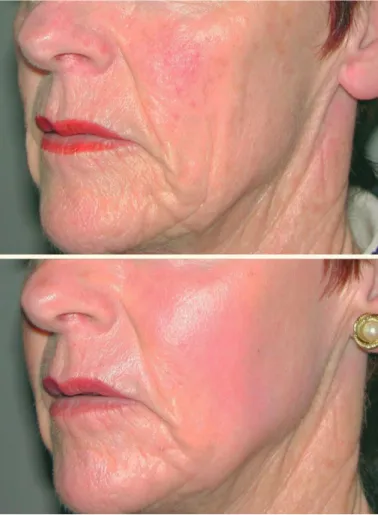 Fig. 1.7.  Before (top)  and 3 months aft er (bottom)  CO 2  laser resurfacing  and fat transfer